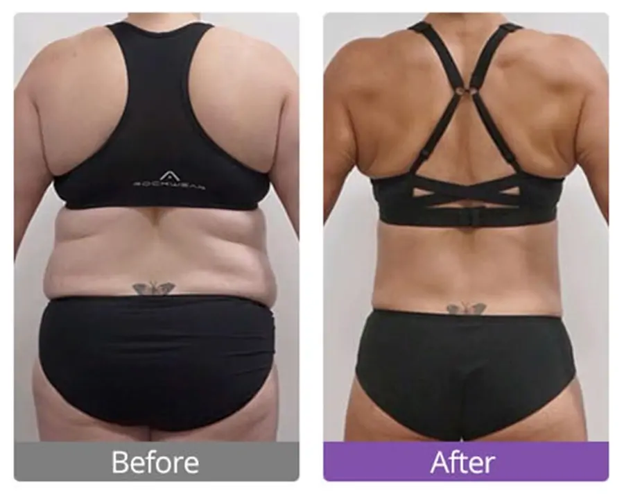 ultrasonic cavitation before and after results works on fat reduction of backs
