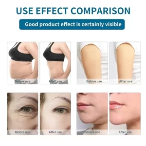 ultrasonic cavitation before and after results 