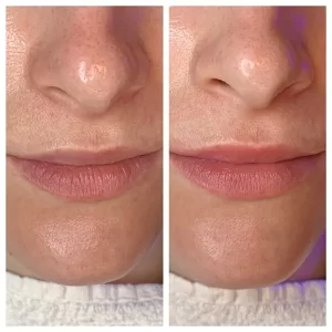 HydraFicial before and after treatment HydraFicial works