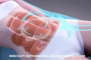 emsculpt machine for fat reducing and muscle building
