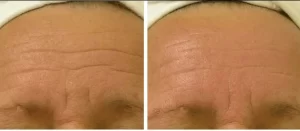 HydraFicial before and after treatment HydraFicial cleaning works