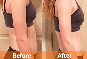 lipo laser rf radio frequency ems muscle stimulator lipo laser before and after 1 treatment does laser lipo work before and after best laser lipo machine 2024